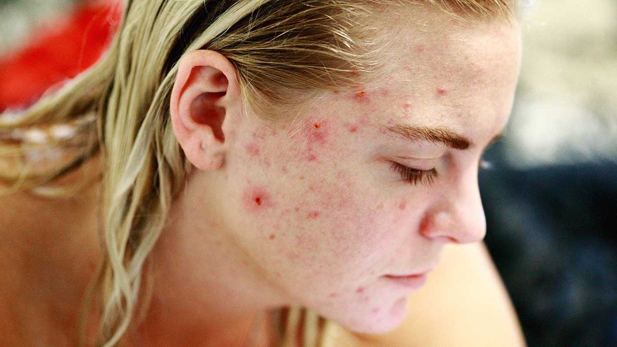 How To Fight The Acne Battle