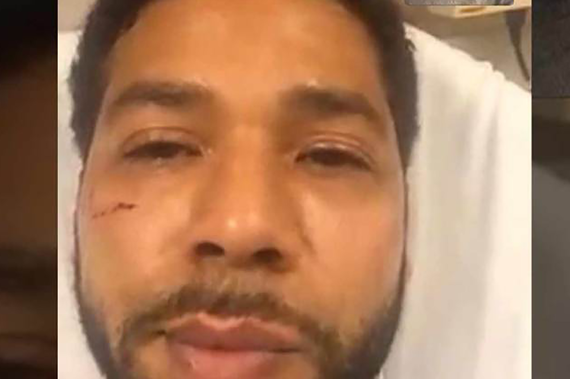 Director and Empire creator, Lee Daniels, shares a screen grab showing Jussie Smollett's injuries obtained during an alleged biased hate crime attack on the 300 block of East North Lower Water Street, Chicago, on January 28, 2019.